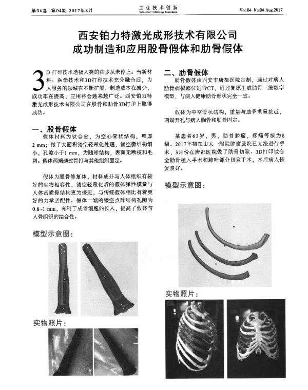 西安铂力特激光成形技术有限公司成功制造和应用股骨假体和肋骨假体