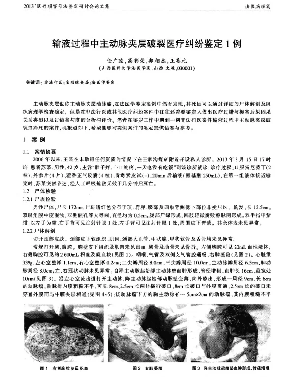 输液过程中主动脉夹层破裂医疗纠纷鉴定1例